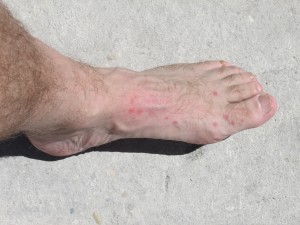 Mosquito bites on my foot